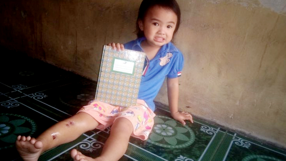 Alexa Benetta, Balita Asal Bukittinggi Alami Tulang Kaki Keropos Jalani Operasi di Sumut