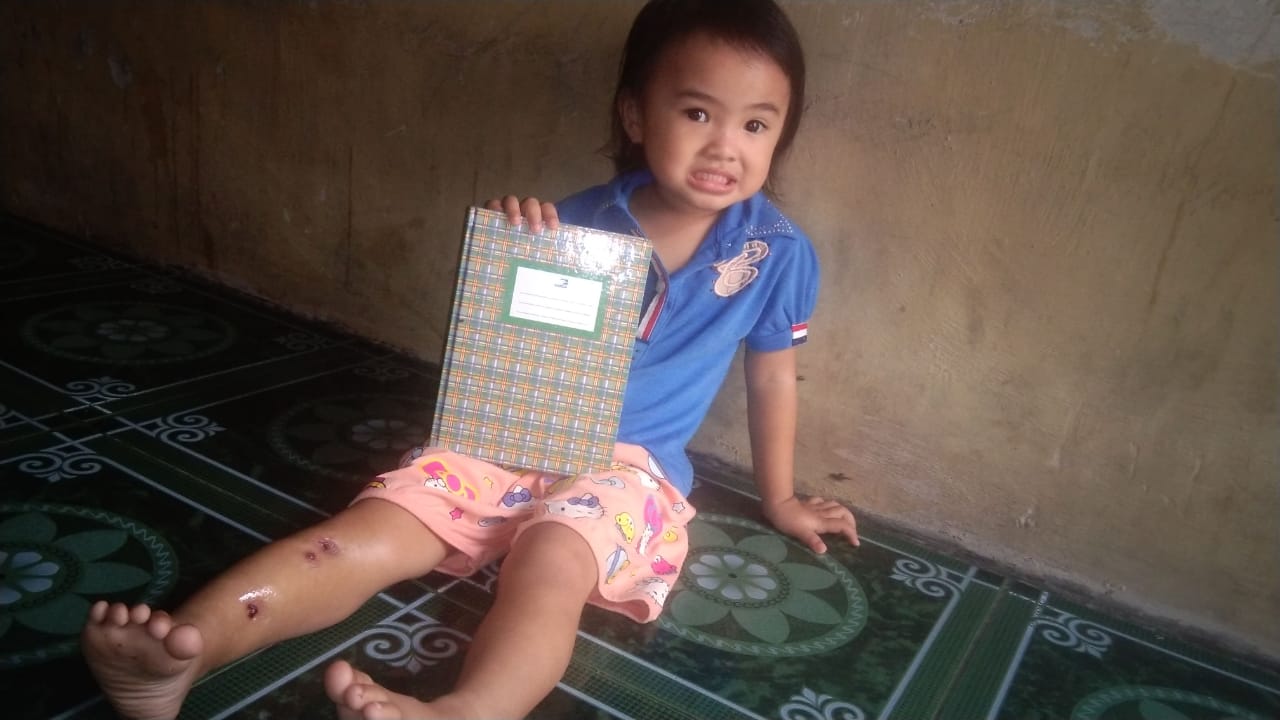 Alexa, Balita Penderita Tulang Kaki Keropos Asal Bukittinggi Butuh Bantuan Dermawan