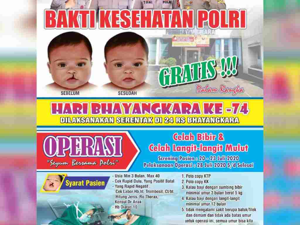 Bakti sosial Polri, operasi bibir sumbing gratis di RS Bhayangkara Sumbar. (Foto: Dok.Polda Sumbar)