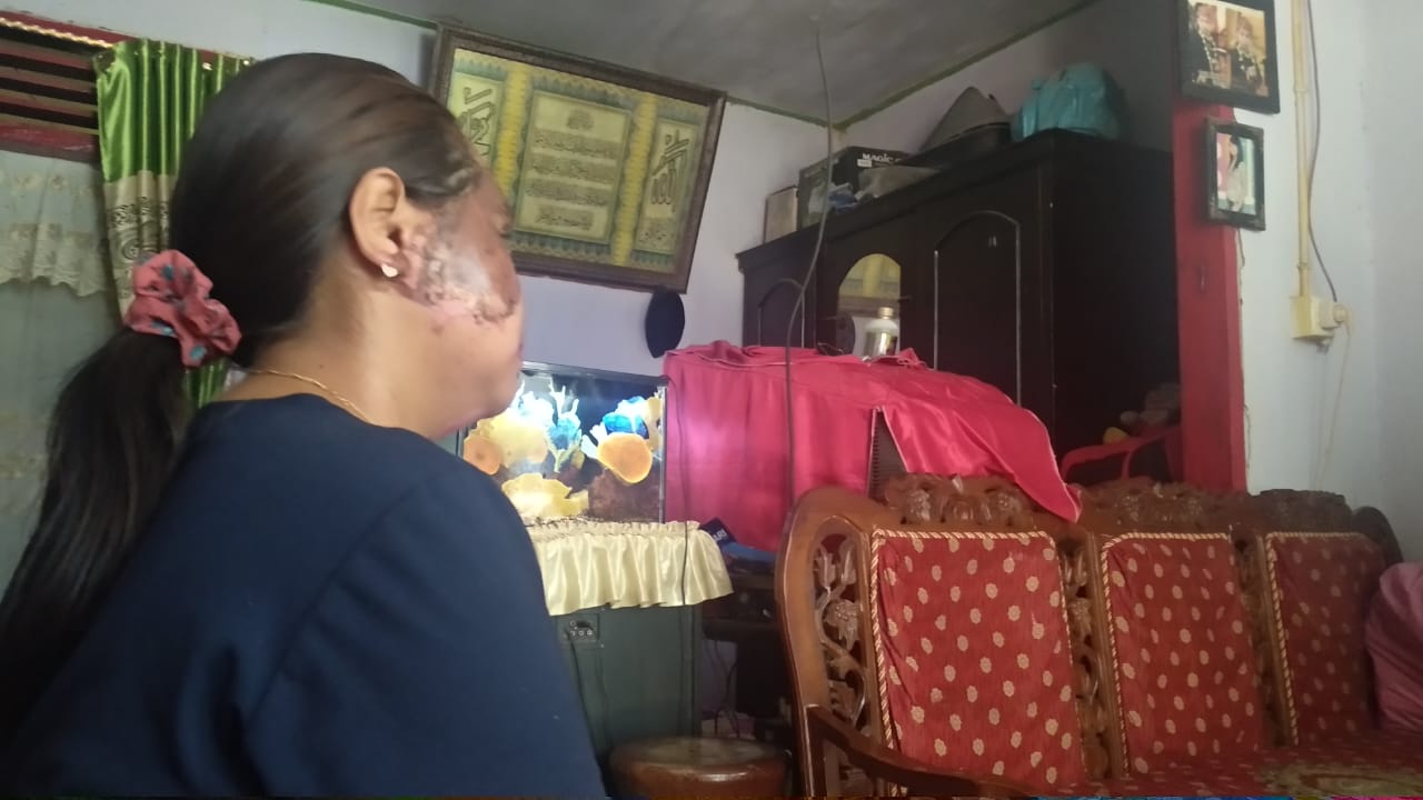 Curhat Ibu Disiram Minyak Panas Gara-gara TikTok: Saya Kangen Anak