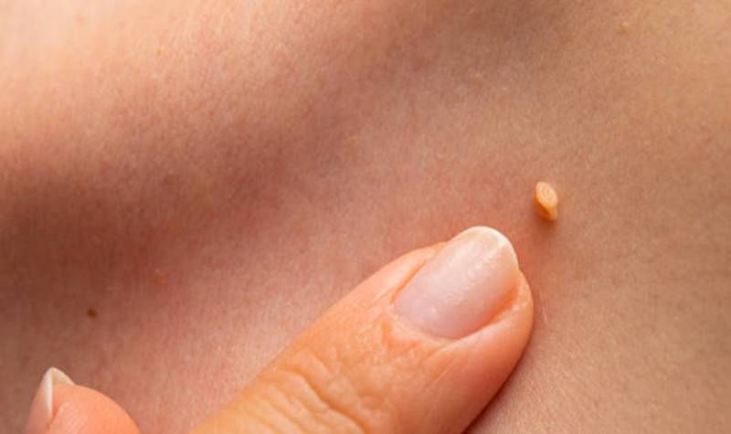 Menghilangkan skin tag