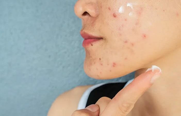 Ketahui Skincare yang Aman untuk Kulit Berjerawat