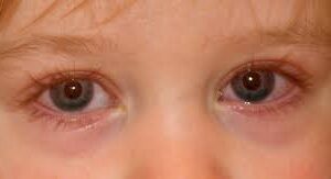 Cara Mengatasi Mata Merah pada Anak: Penanganan Konjungtivitis Viral yang Efektif